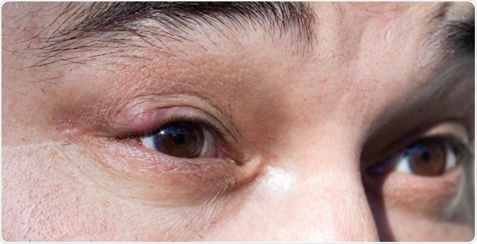 Blepharitis inflammation. Image Credit: donikz / Shutterstock